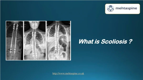 Dr Jwalant Mehta - What is Scoliosis? | Best Spinal Surgeons in UK