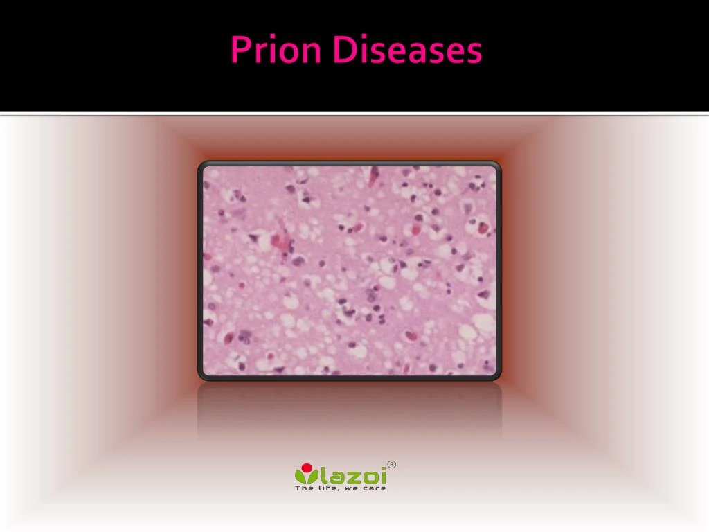 prion diseases