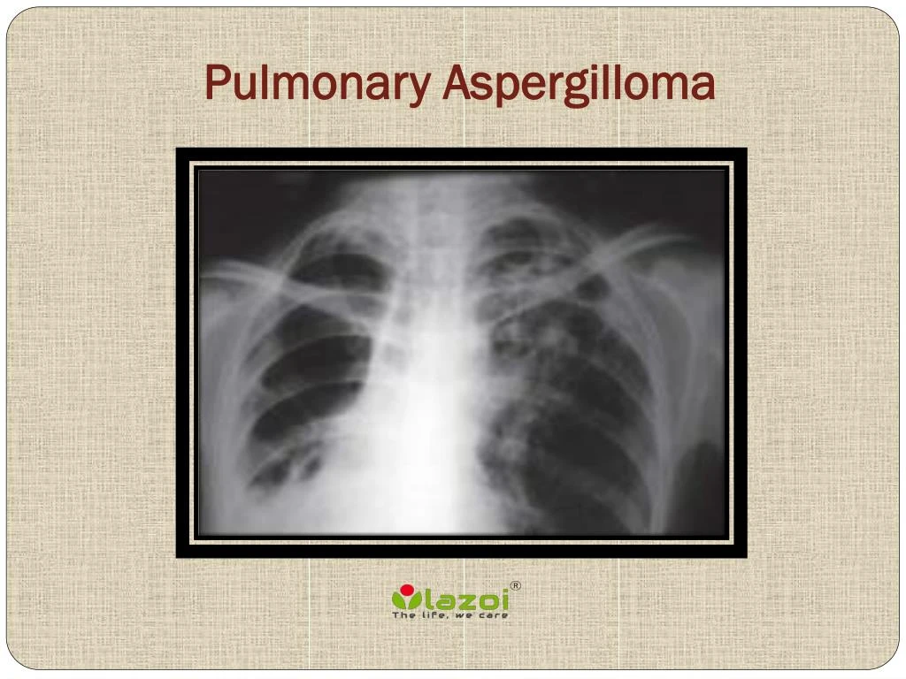 pulmonary aspergilloma