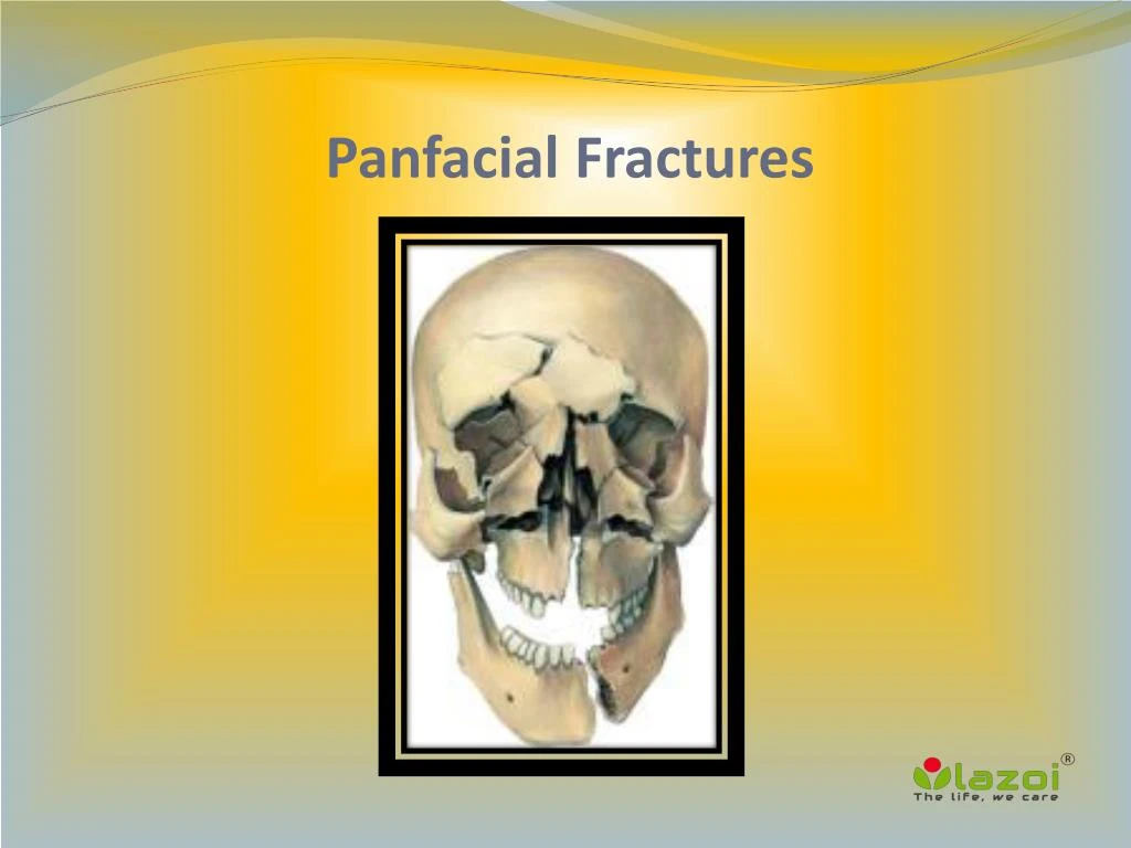 panfacial fractures