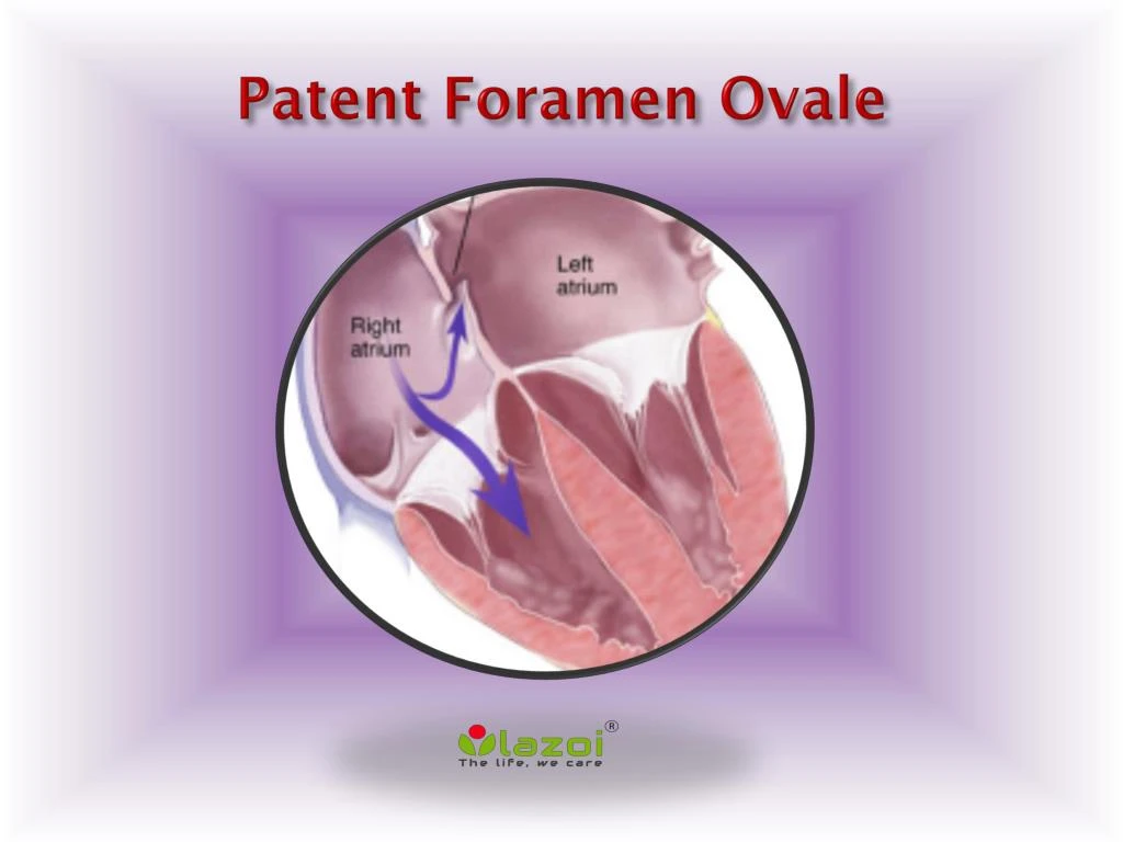 patent foramen ovale