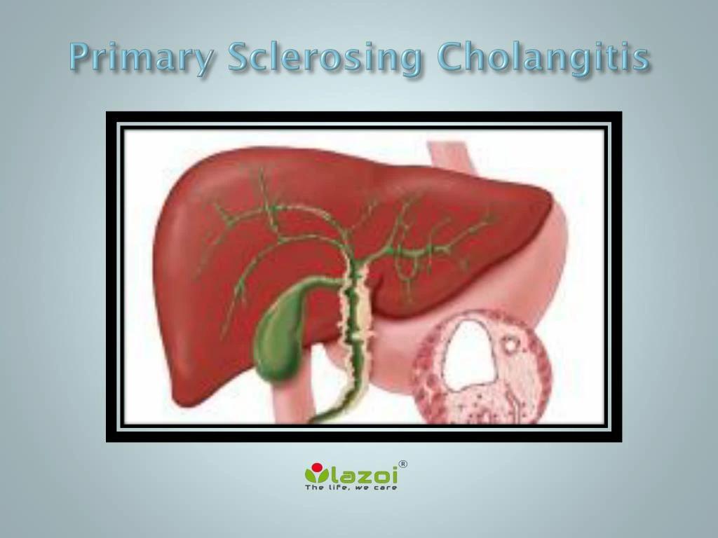 primary sclerosing cholangitis
