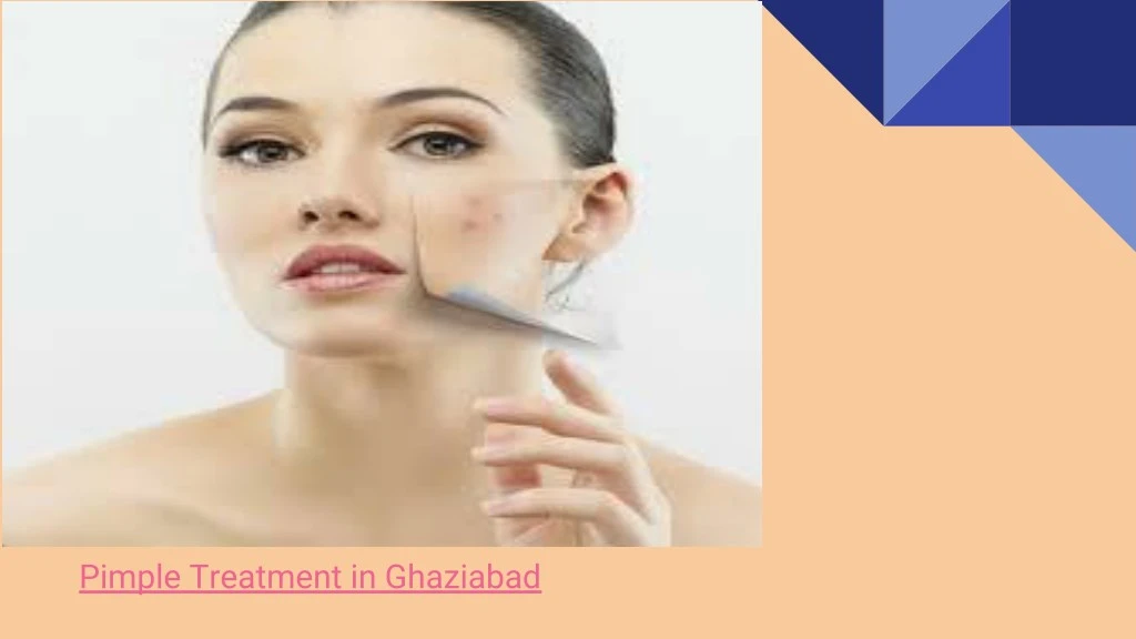 pimple treatment in ghaziabad