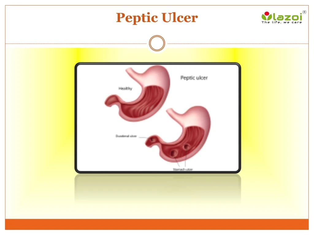 peptic ulcer