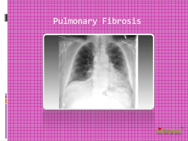 Pulmonary Fibrosis: Prognosis, Symptoms, Treatment and Causes