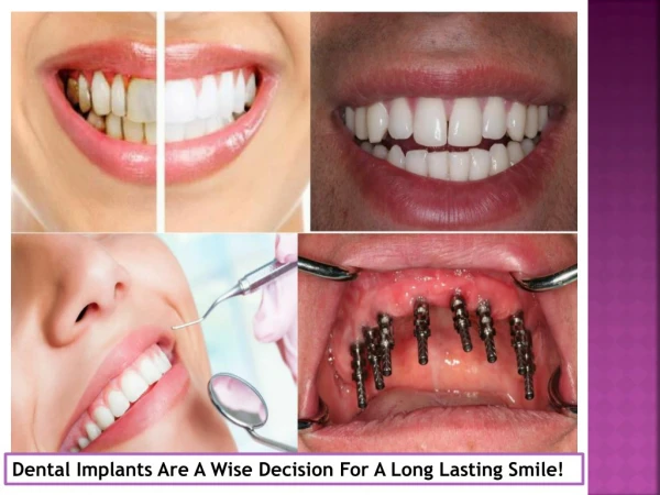 Dental Implants Are A Wise Decision For A Long Lasting Smile!