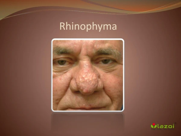 Rhinophyma: Causes, Symptoms, Daignosis, Prevention and Treatment