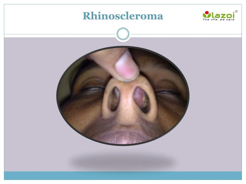 rhinoscleroma