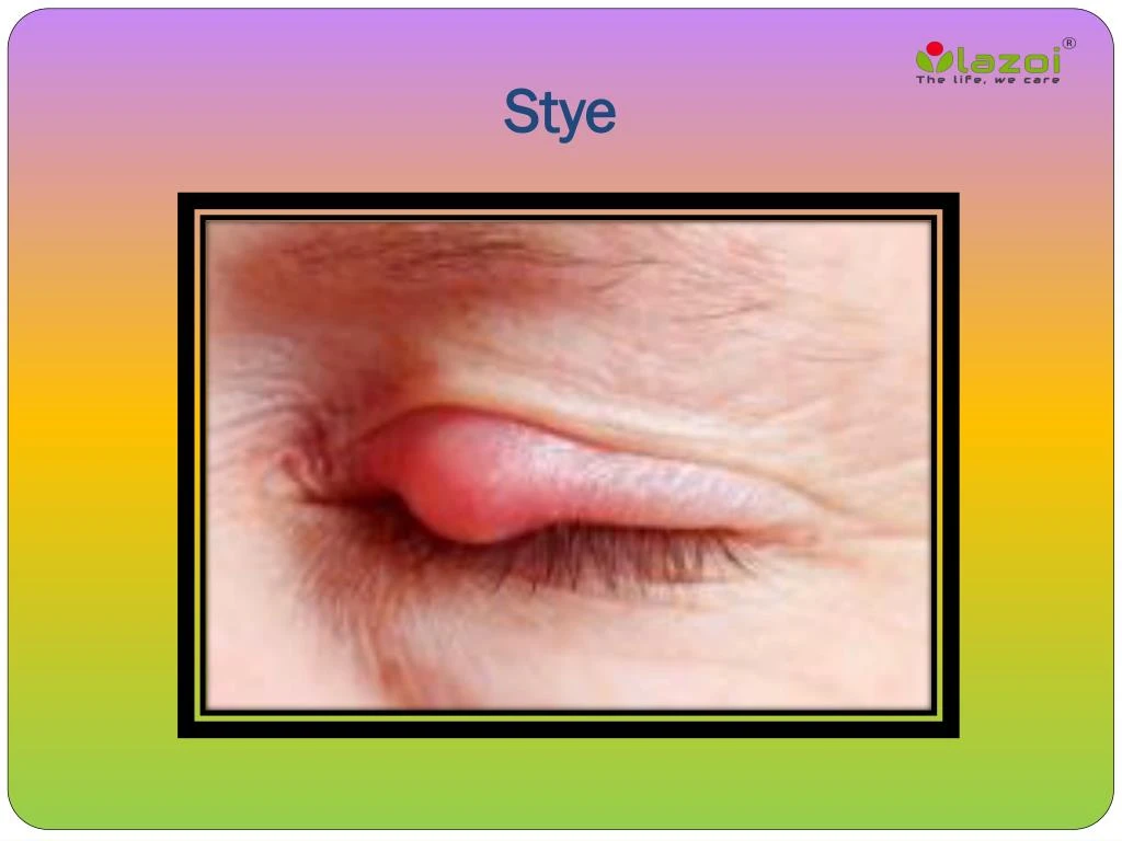 Ppt Stye Causes Symptoms Daignosis Prevention And Treatment Powerpoint Presentation Id 