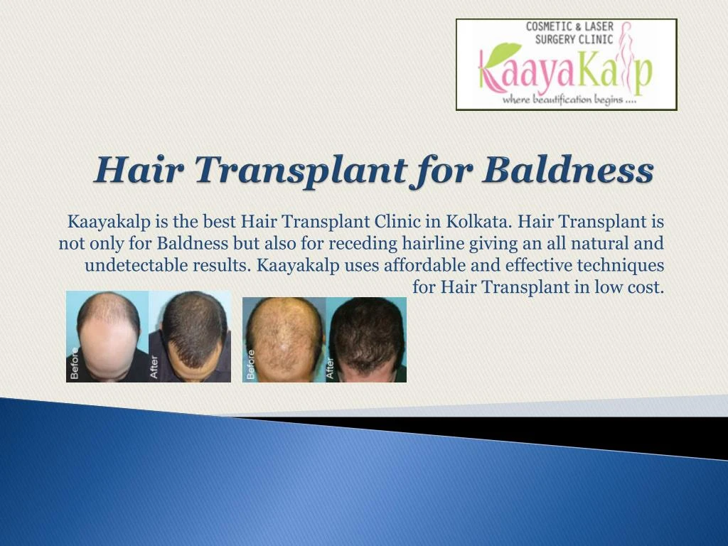 hair transplant for baldness