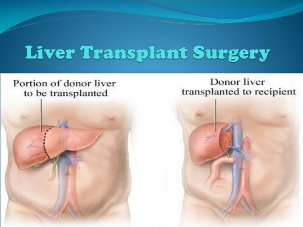 cost of Liver Transplant surgery in India