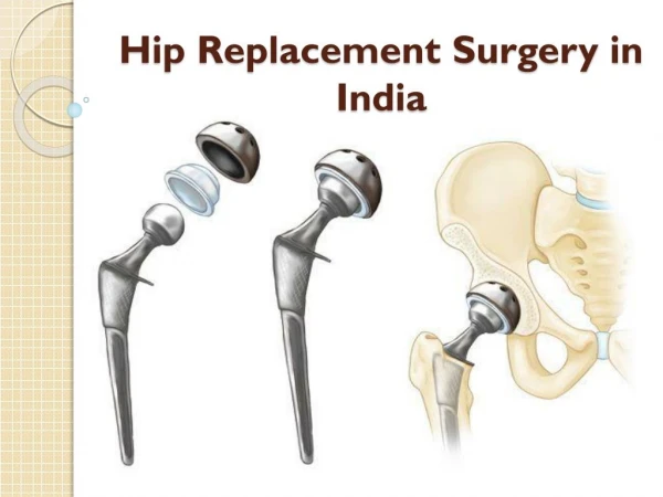 Cost of hip replacement Surgery in India