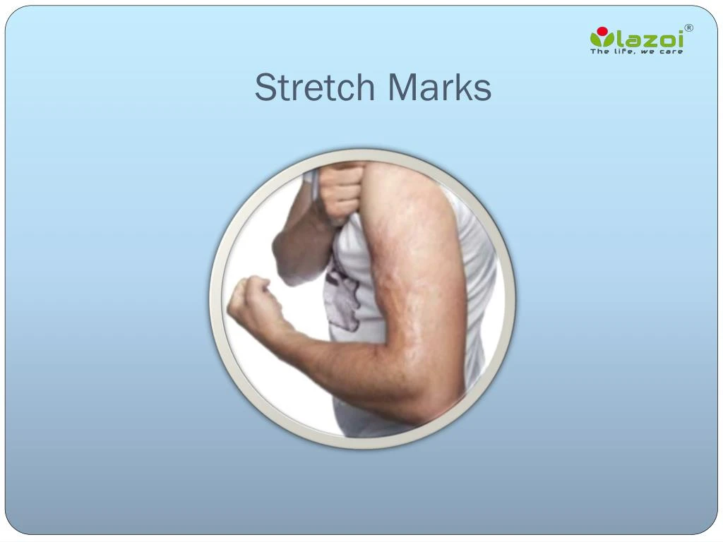 stretch marks