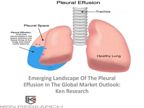 Global Pleural effusion Market Research Report, Analysis, Opportunities, Forecast, Size, Segmentation, Competitive Analy