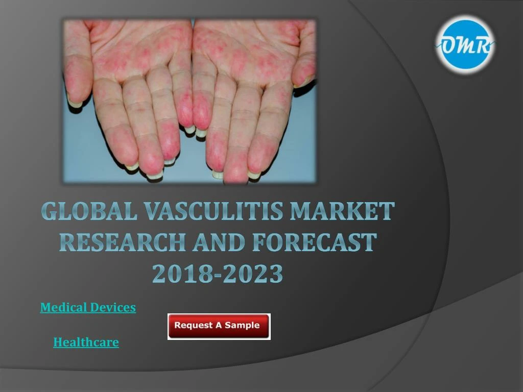 global vasculitis market research and forecast 2018 2023