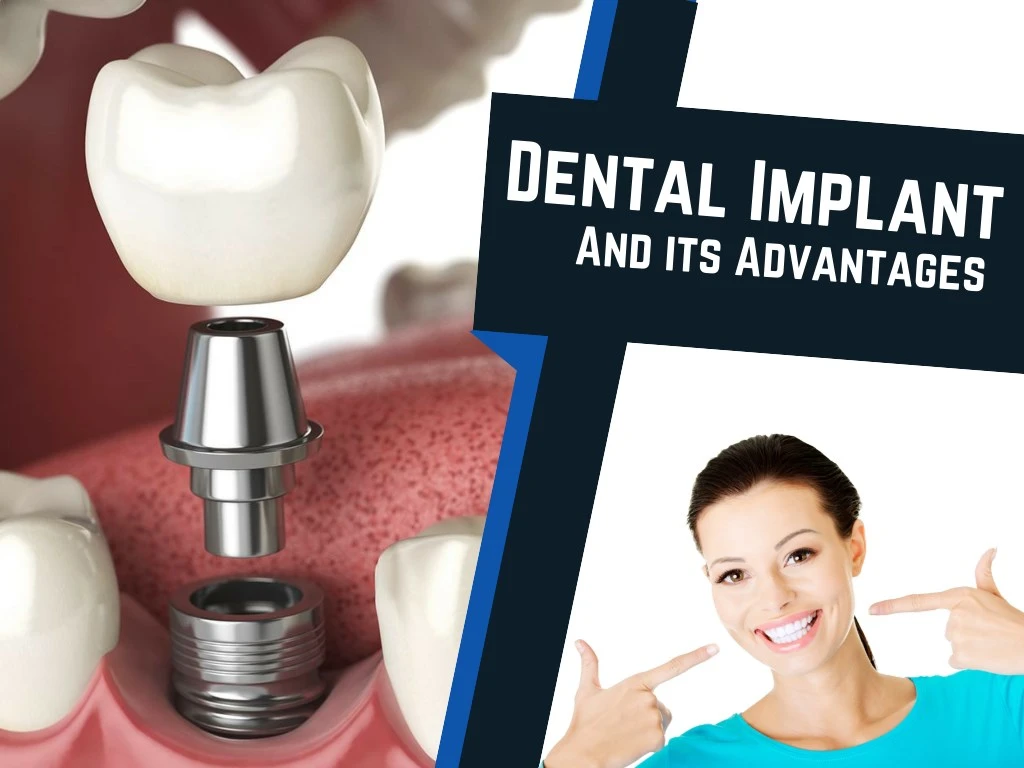 dental implant and its advantages