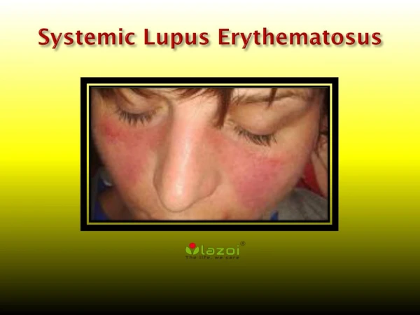 Systemic Lupus Erythematosus: Causes, Symptoms, Daignosis, Prevention and Treatment