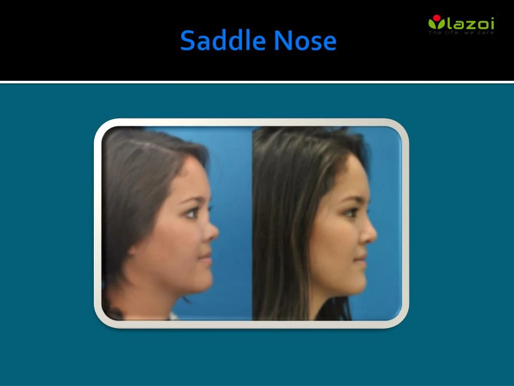 saddle nose