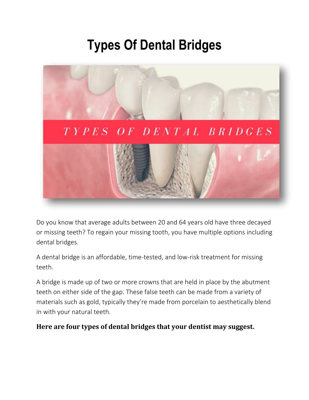 types of dental bridges