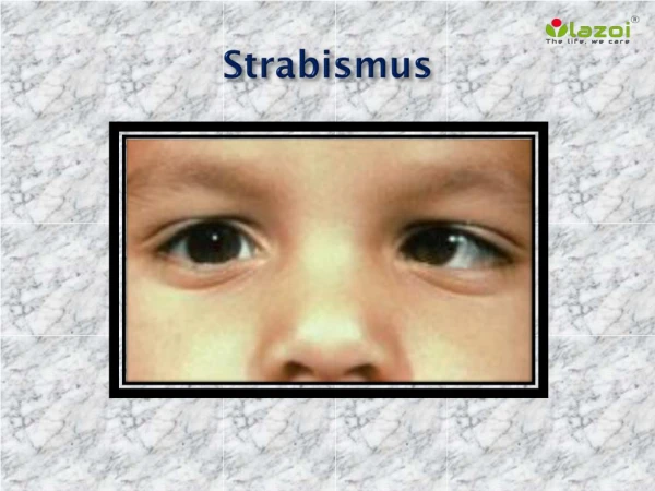 Strabismus: Causes, Symptoms, Daignosis, Prevention and Treatment