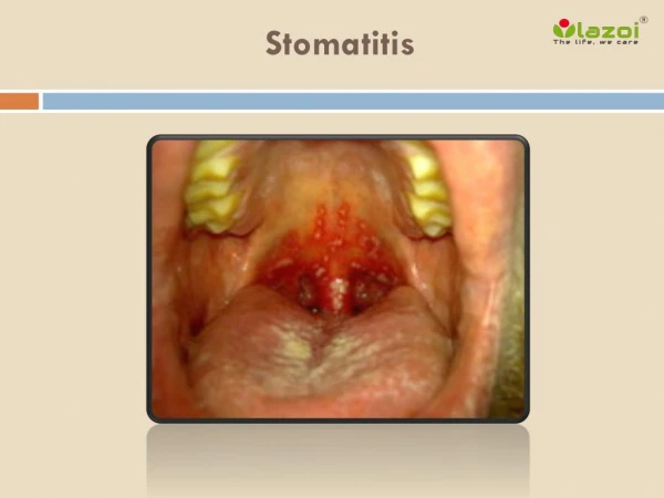 Stomatitis: Causes, Symptoms, Daignosis, Prevention and Treatment