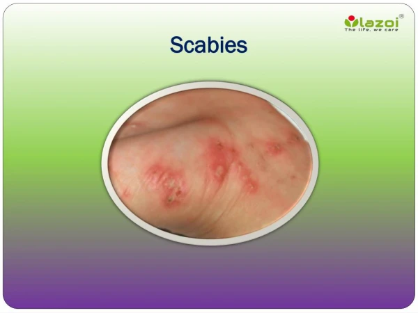 Scabies: Causes, Symptoms, Daignosis, Prevention and Treatment