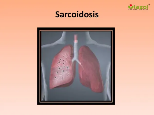 Sarcoidosis: Causes, Symptoms, Daignosis, Prevention and Treatment