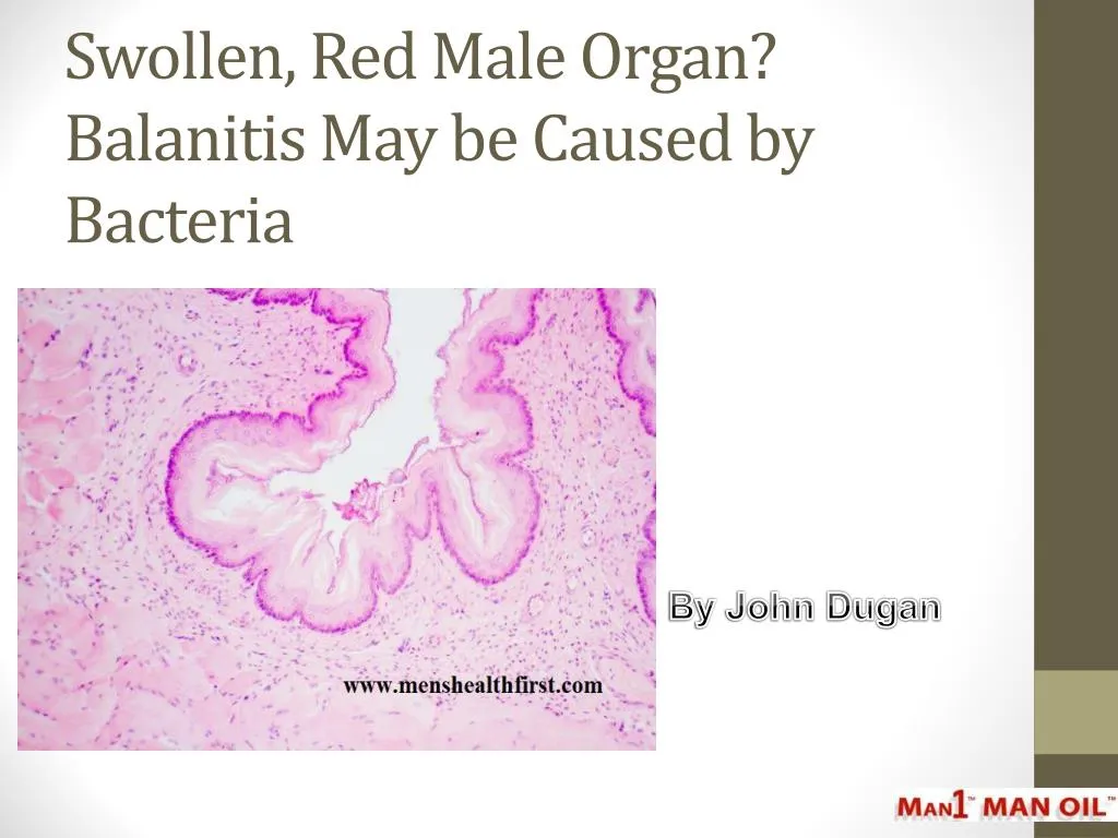 swollen red male organ balanitis may be caused by bacteria