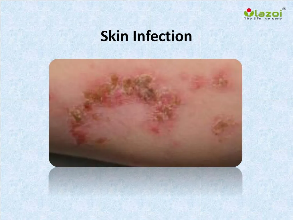 skin infection