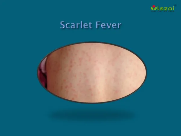 Scarlet Fever: Causes, Symptoms, Treatment and Prevention