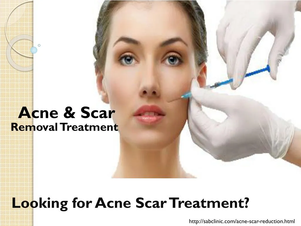 looking for acne scar treatment