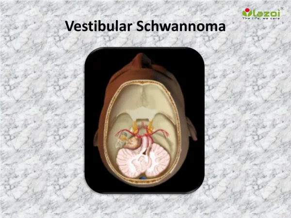 Vestibular Schwannoma: Causes, Symptoms, Daignosis, Prevention and Treatment