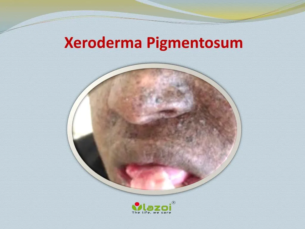 Ppt Xeroderma Pigmentosum Causes Symptoms Daignosis Prevention