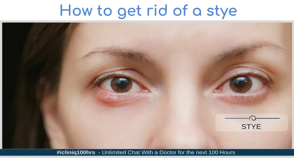 how to get rid of a stye