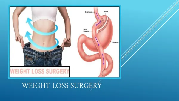 Weight Loss Surgery - Treatment of Obesity