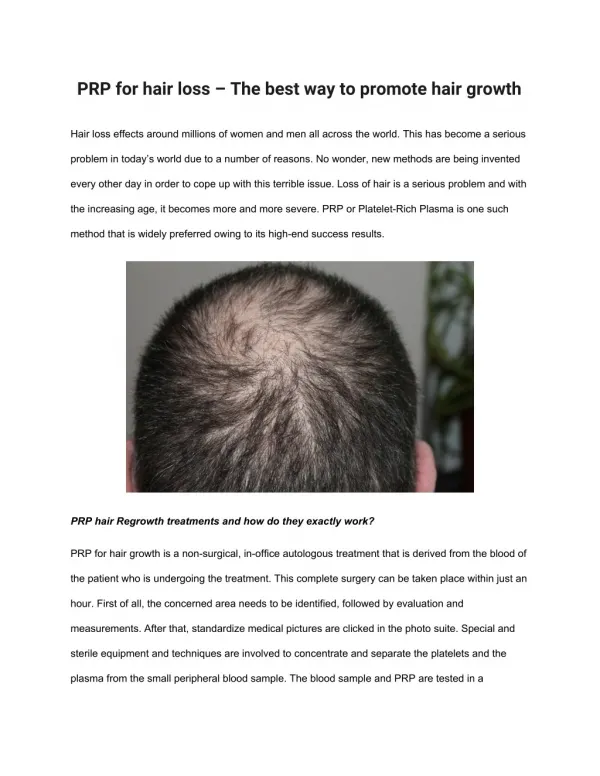 PRP for hair loss – The best way to promote hair growth