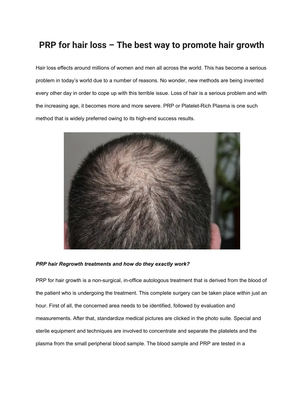 prp for hair loss the best way to promote hair