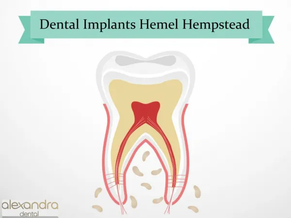 Dental Implants Hemel Hempstead