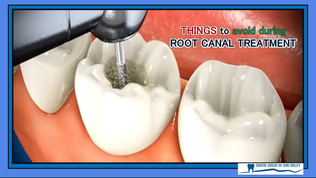 things to avoid during root canal treatment