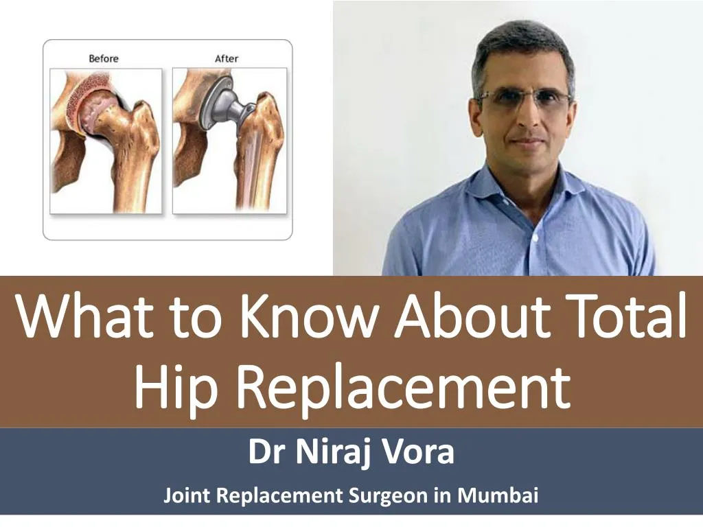 what to know about total hip replacement