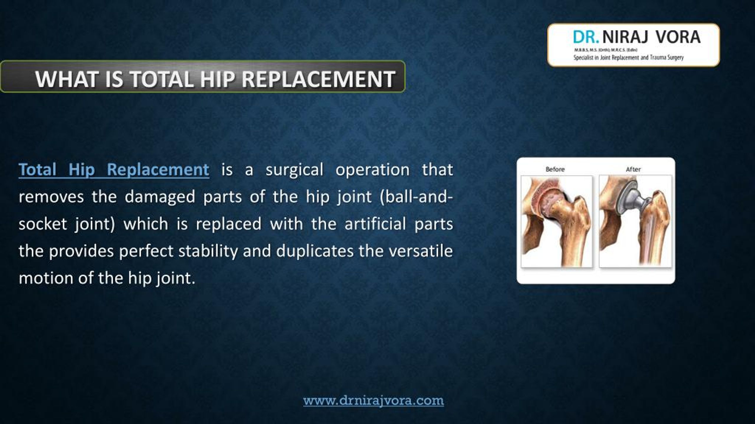 PPT - What to Know About Total Hip Replacement - Dr Niraj Vora Mumbai ...