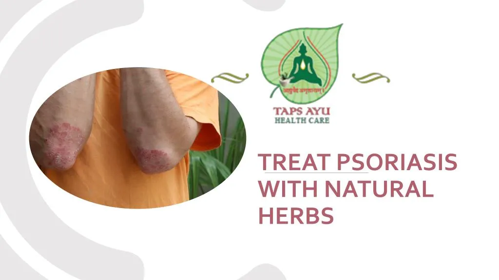 treat psoriasis with natural herbs