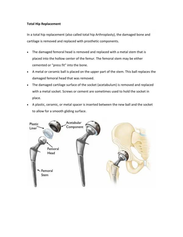 Total Hip Replacement Surgery pdf | Shri Ramchandra Joint Relacement Centre in Guntur | Vijayawada | Prakasam | AP | I