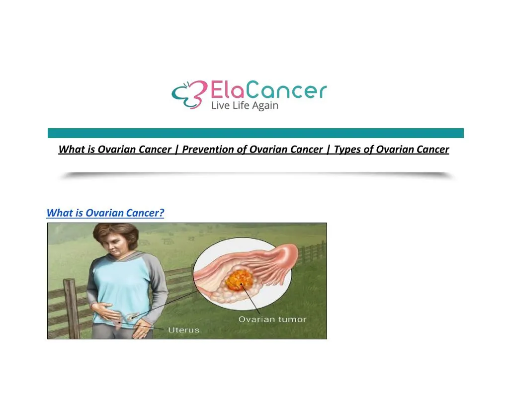 what is ovarian cancer prevention of ovarian