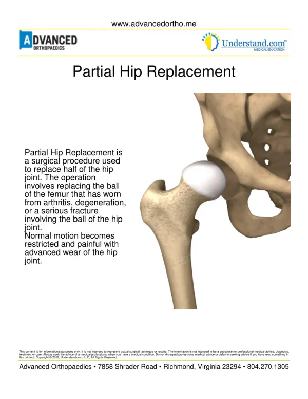 Partial Hip Replacement Surgery pdf | Shri Ramchandra Joint Relacement Centre in Guntur | Vijayawada | Prakasam | AP