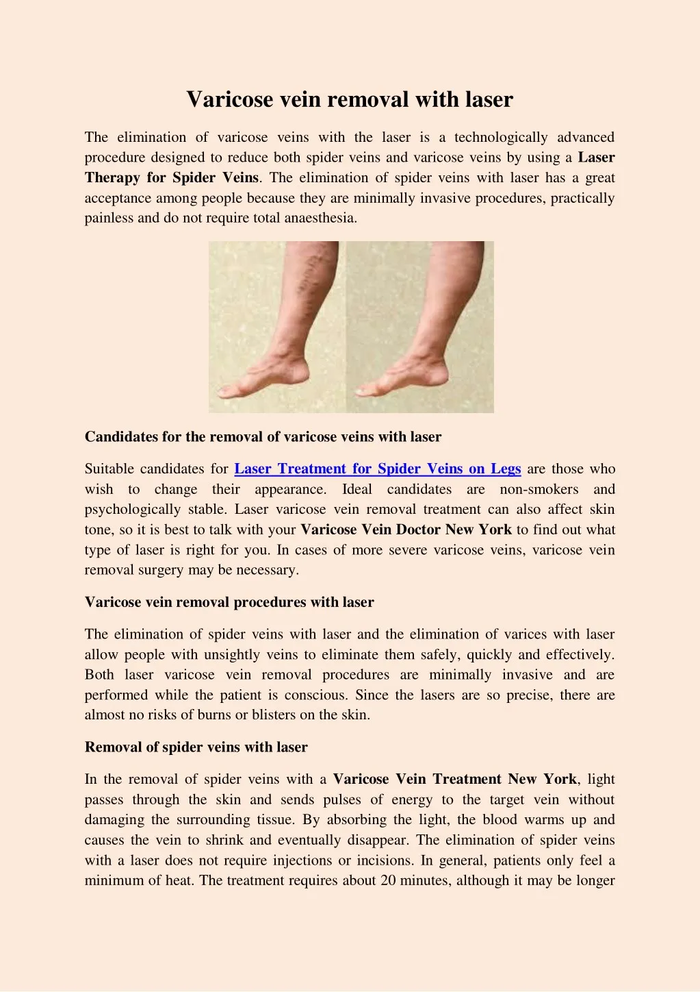 varicose vein removal with laser