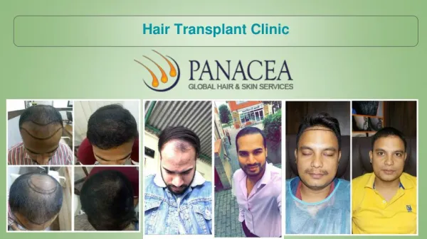 Things To Consider Before Entering into Any Hair Transplant Clinic