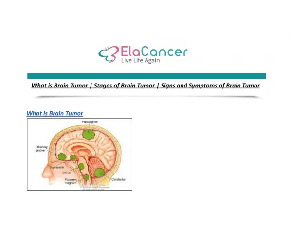 What is Brain Tumor | Stages of Brain Tumor | Signs and Symptoms of Brain Tumor