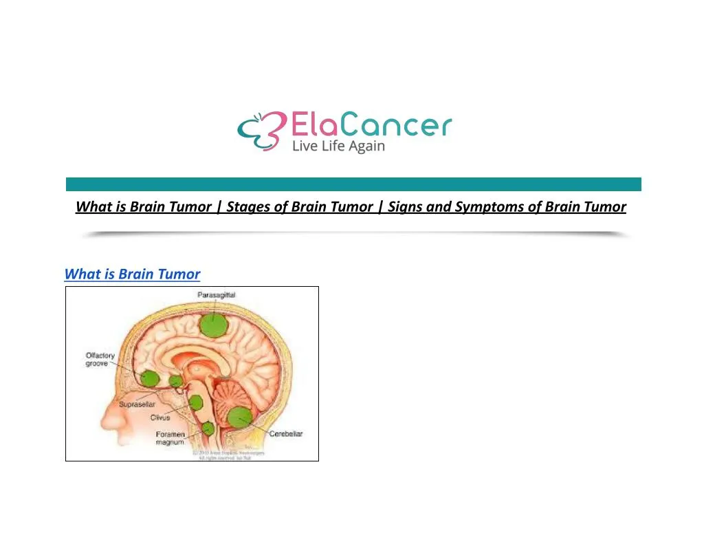 what is brain tumor stages of brain tumor signs