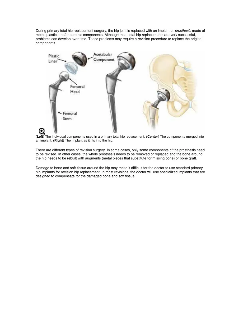 during primary total hip replacement surgery